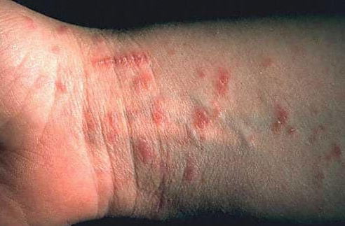 uyuz hastalığı belirtileri