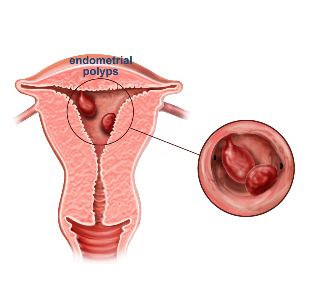 endometrial-polip