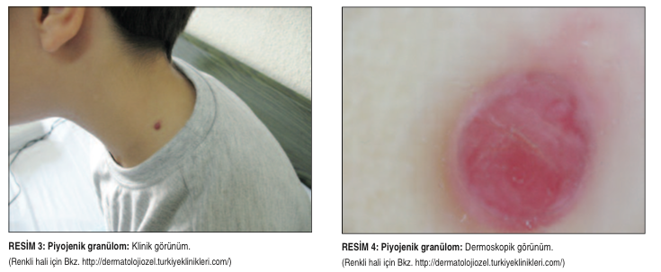 granülom nedir